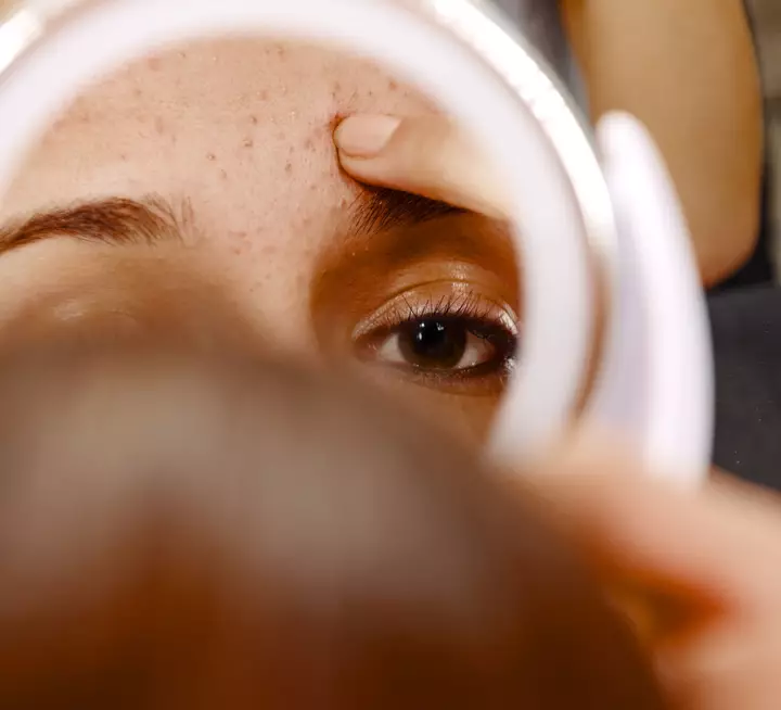 It’s Not a Whitehead, It’s Milia—Here's How to Treat It
