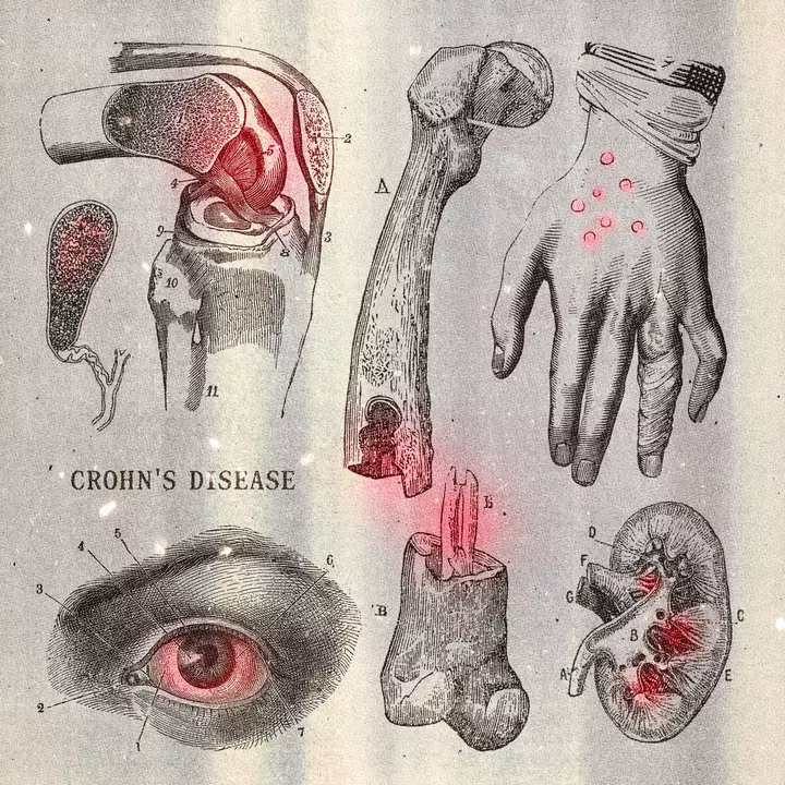 6 Crohn’s Disease Symptoms That Have Nothing to Do with Your Gut
