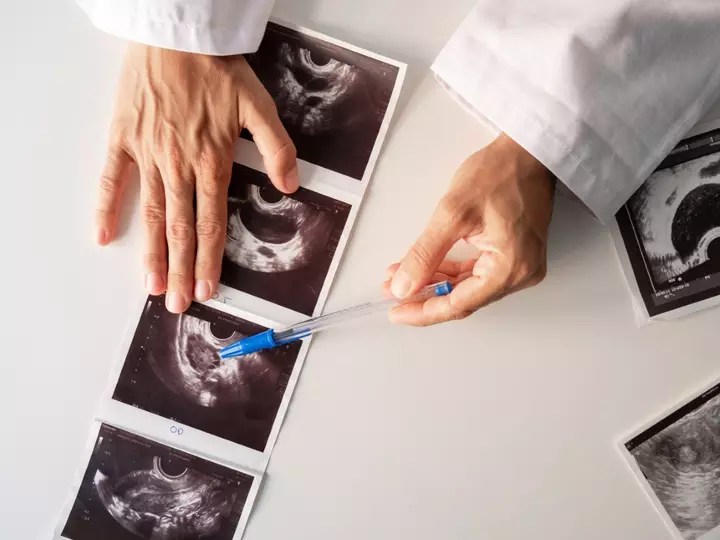 Condition Affecting Millions of Women Studied for Possible Dementia Link