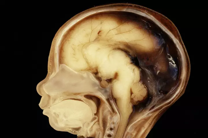 What are microchimeric cells doing to our brain?