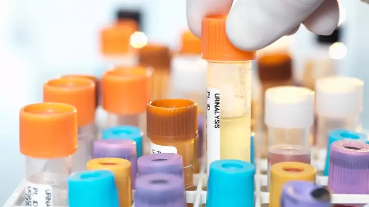 A proof-of-concept test can spot bladder cancer in urine