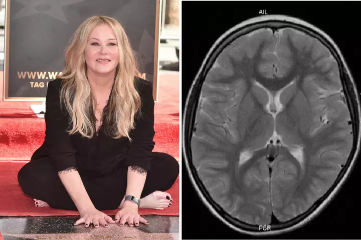MS Symptoms Explained as Christina Applegate Shares Misdiagnosis
